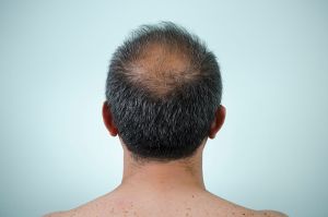 Alopecia poate fi un simptom pe termen lung al coronavirusului